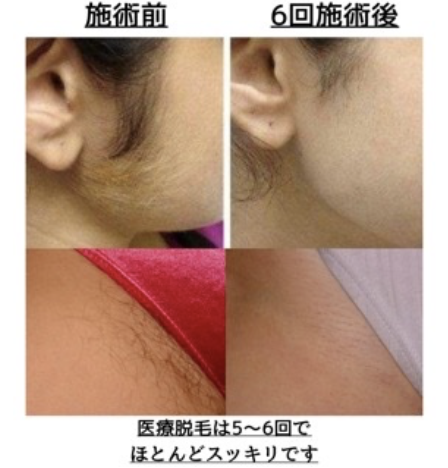 医療 脱毛 5 回 効果