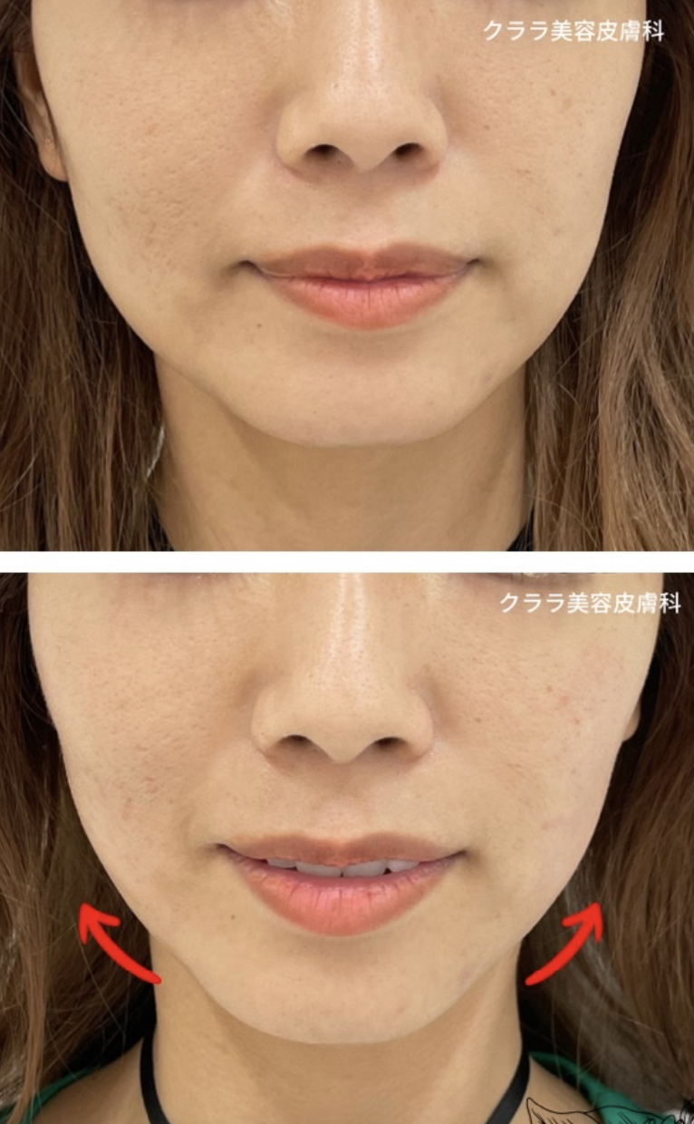 福岡天神 医療ハイフ たるみ治療 症例写真