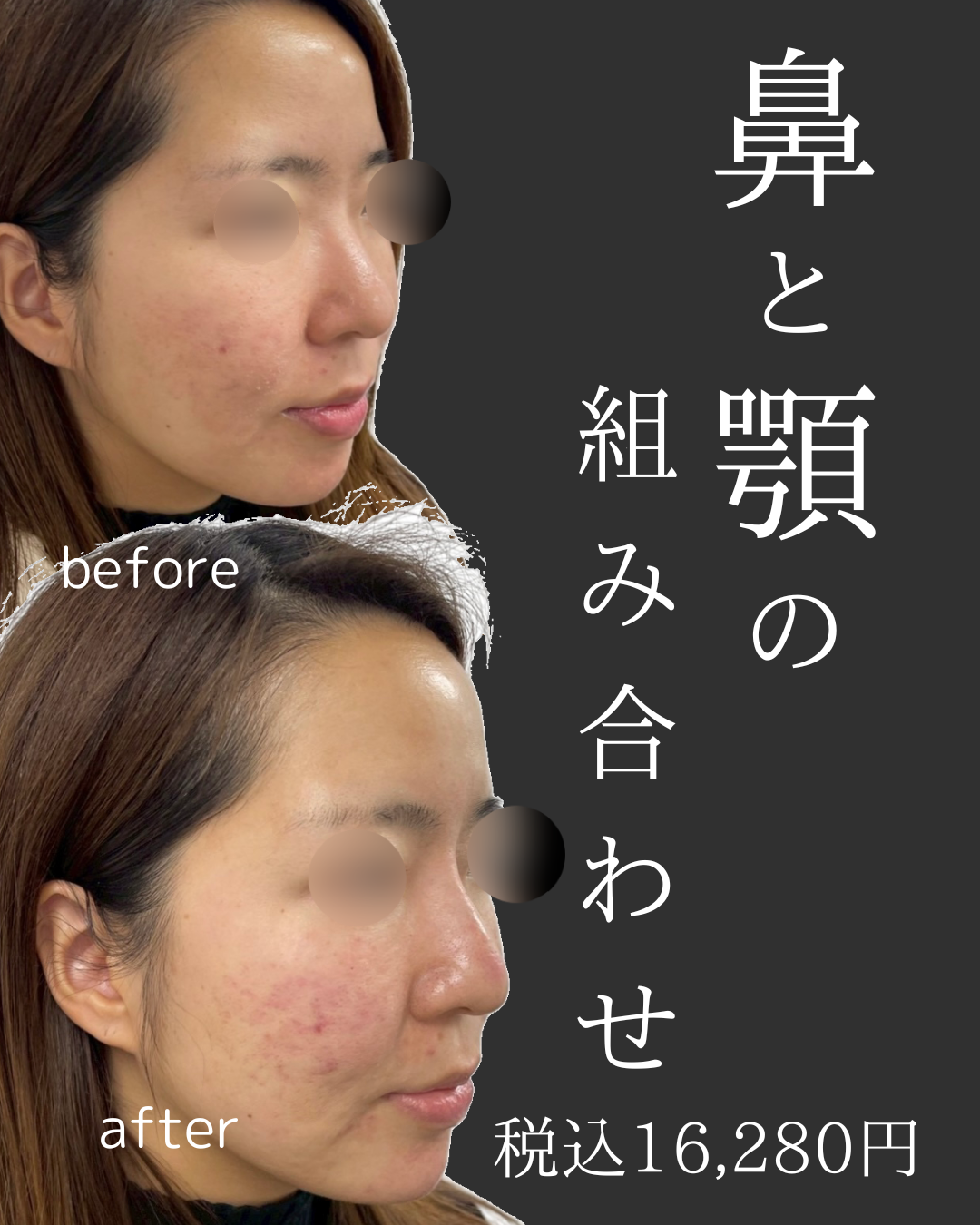 福岡天神 鼻ヒアルロン酸 症例写真 after