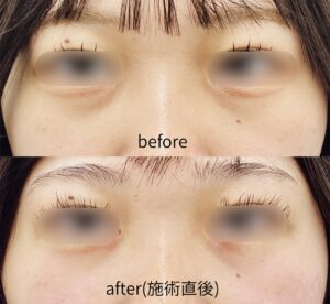 福岡天神 20代女性 切らないクマ取り 施術直後