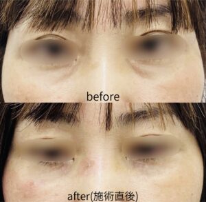 福岡天神 40代女性 切らないクマ取り 施術直後