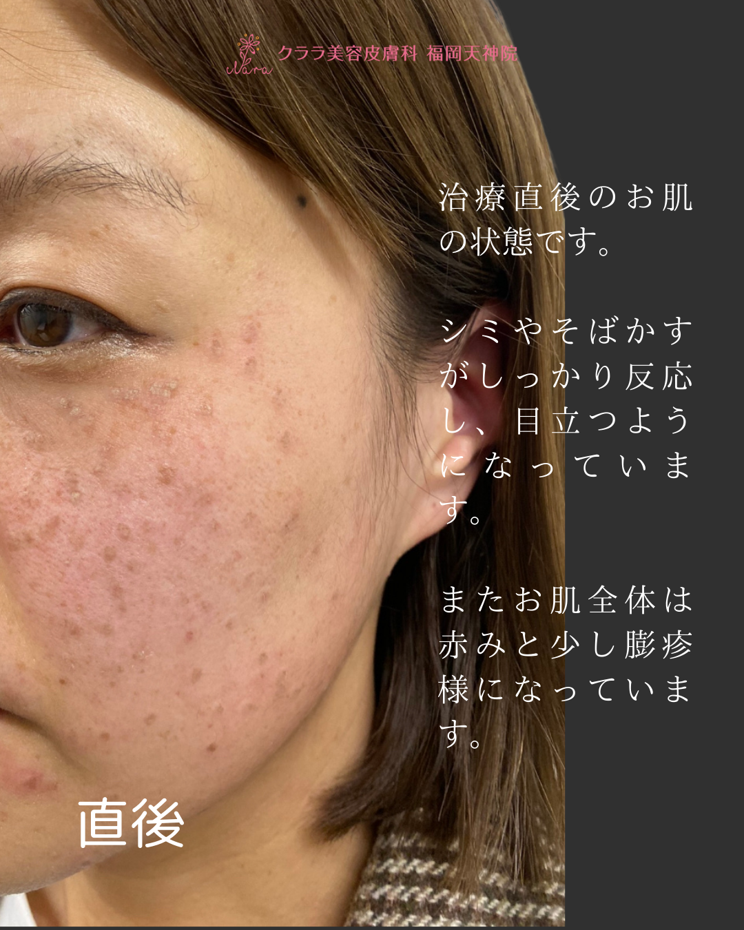 ピコスポット 治療直後