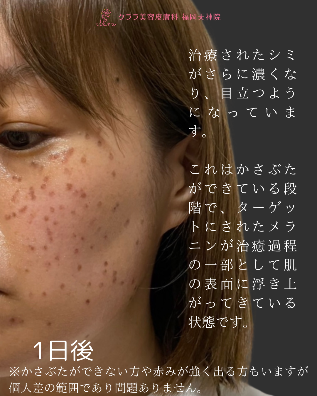 ピコスポット 1日後