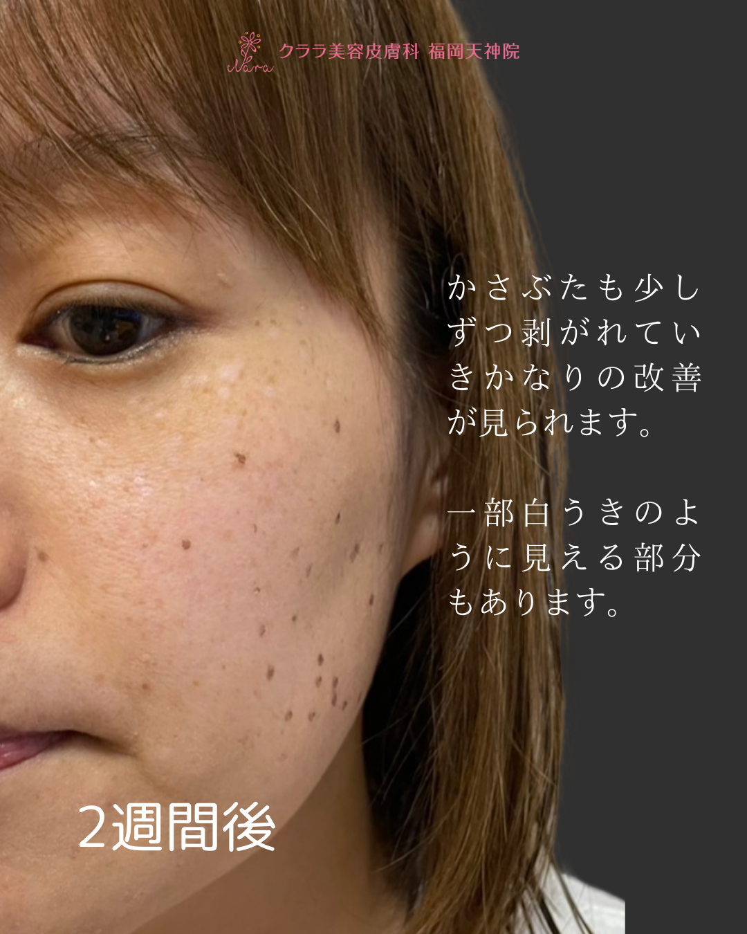 ピコスポット 2週間後