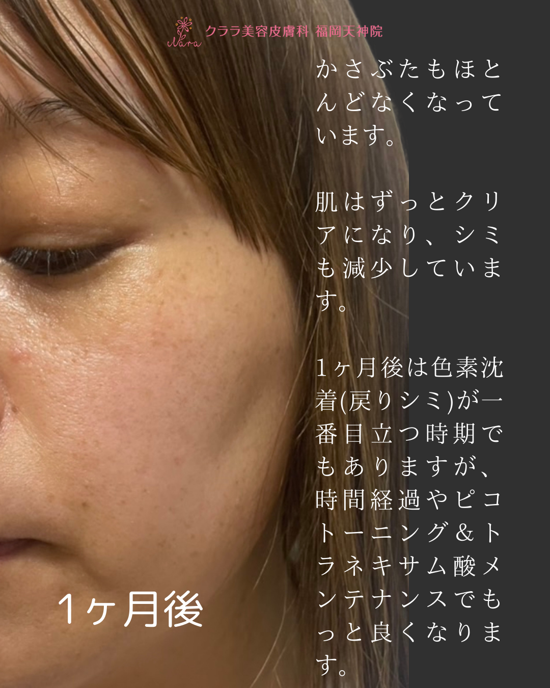 ピコスポット 1ヶ月後