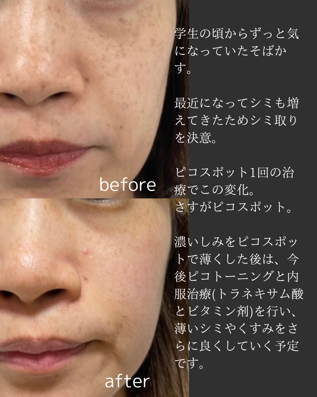 ピコスポット 1回 After