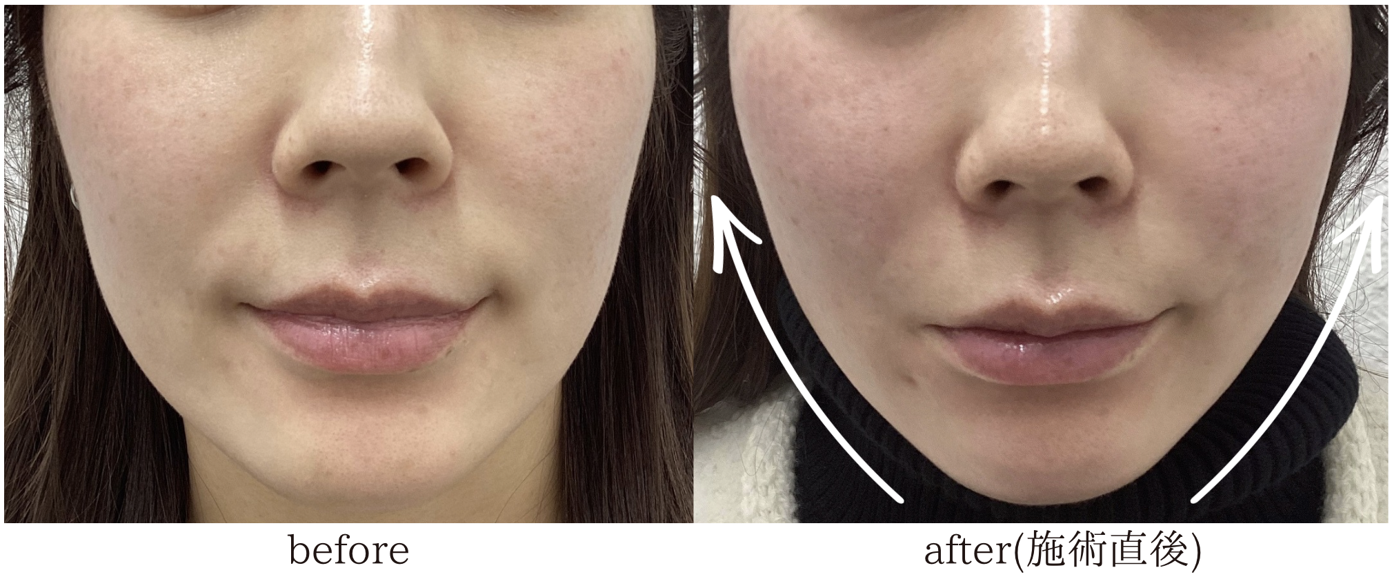糸リフト 30代女性 症例
