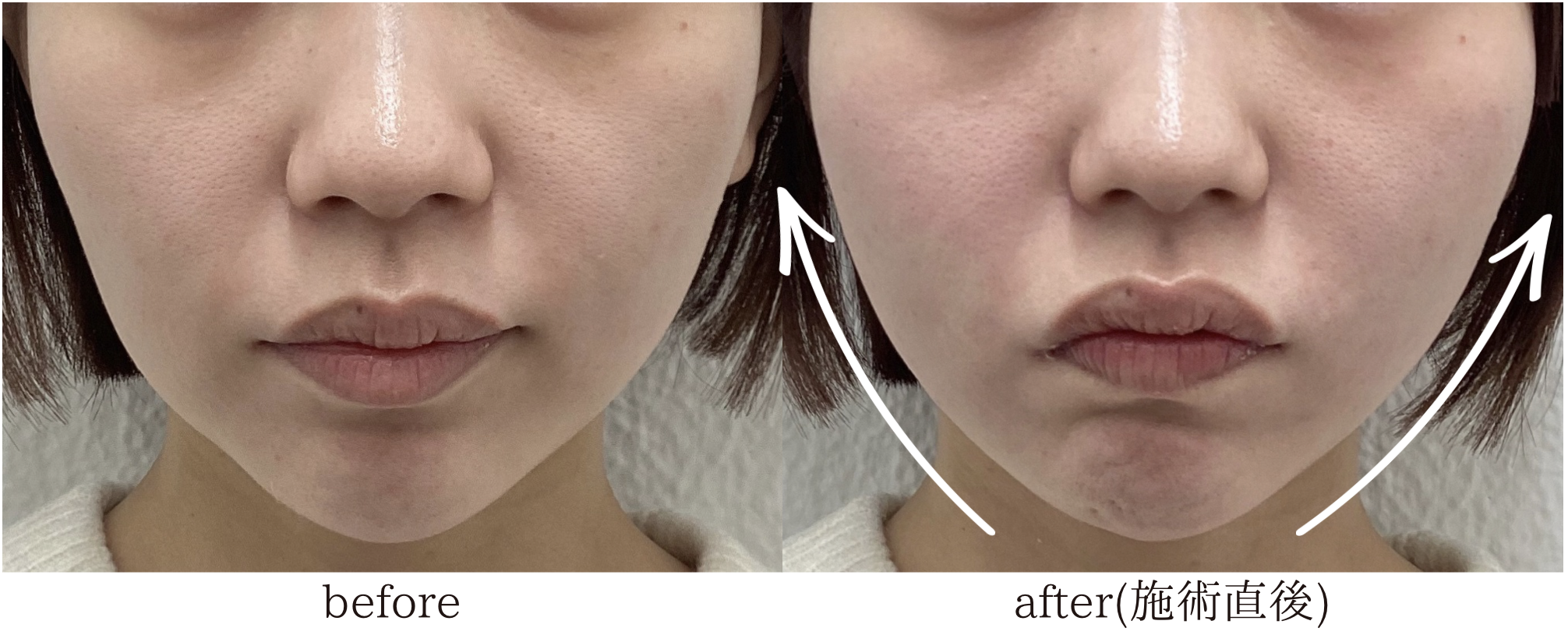 糸リフト 20代女性 症例