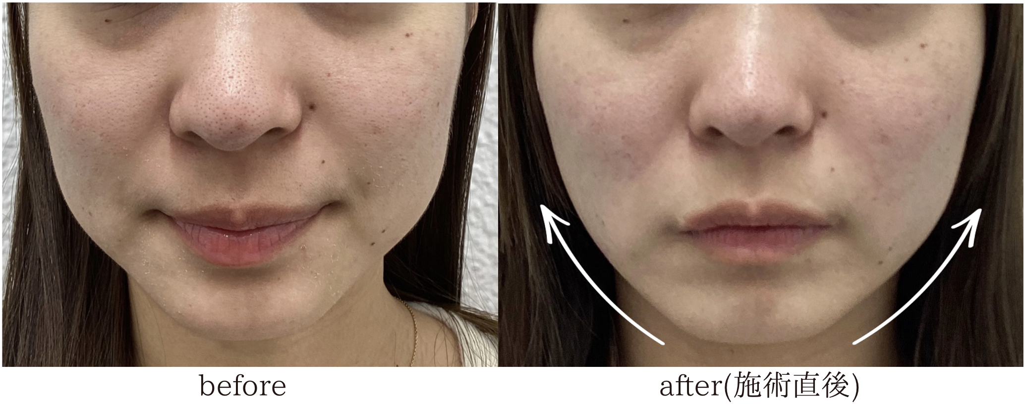 糸リフト 20代女性 症例