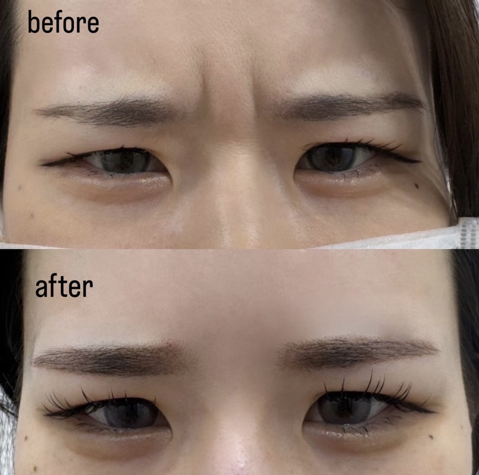 福岡天神 眉間ボトックス 症例写真