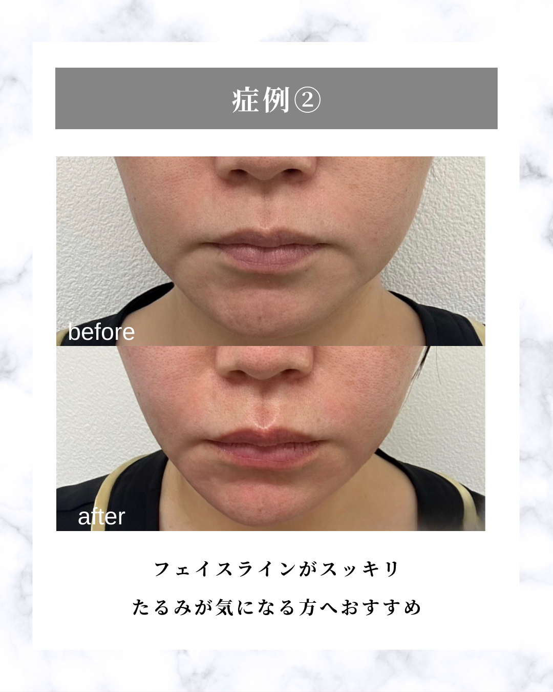 ミラウェーブ 二重あご 症例