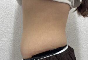 マンジャロ・ミラウェーブ 下腹部 症例 After