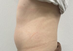 マンジャロ・ミラウェーブ 下腹部 症例 Before