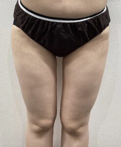 マンジャロ・ミラウェーブ 太もも・お尻 症例 Before