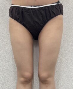 マンジャロ・ミラウェーブ 太もも・お尻 症例 After