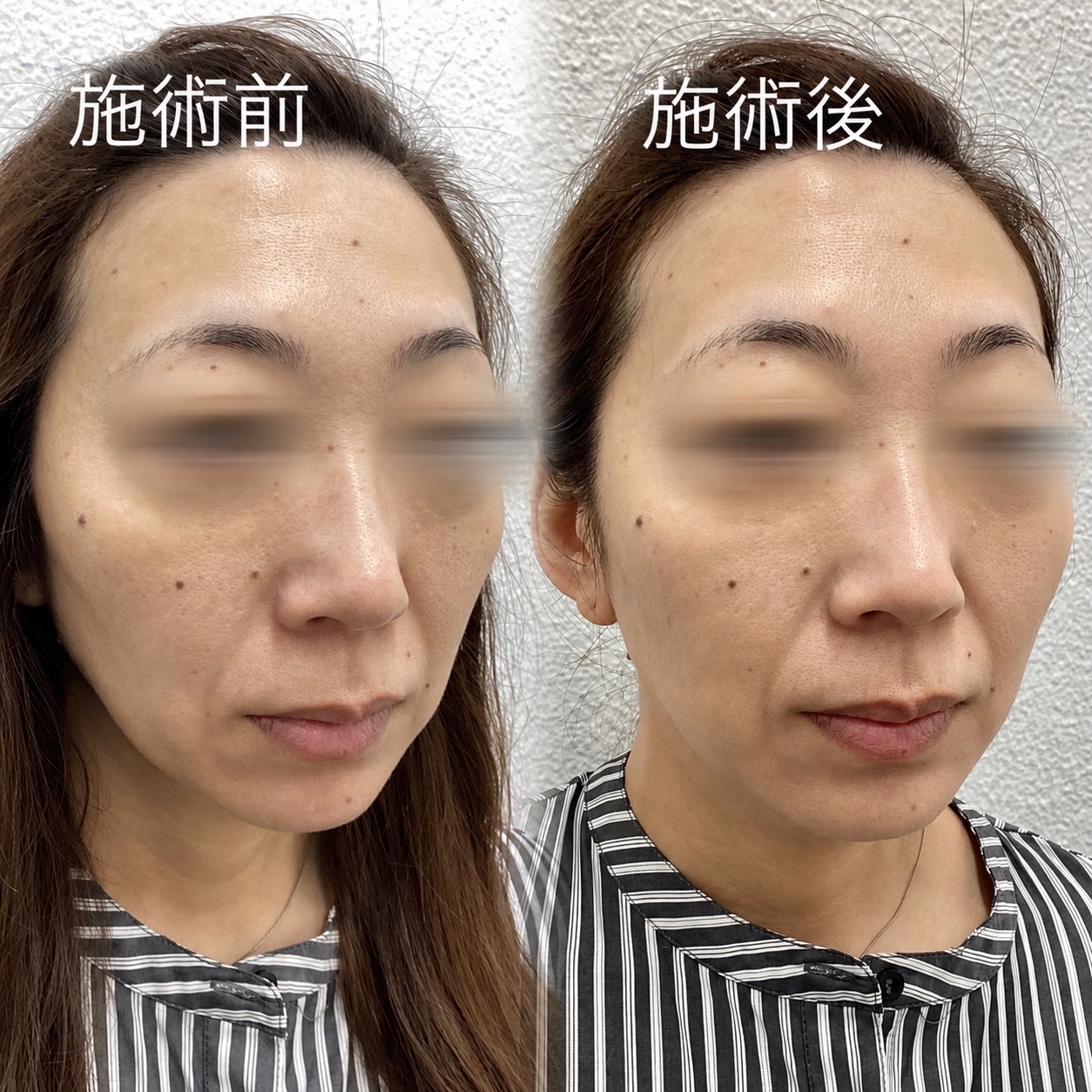 ジャルプロスーパーハイドロ 症例写真 施術前後