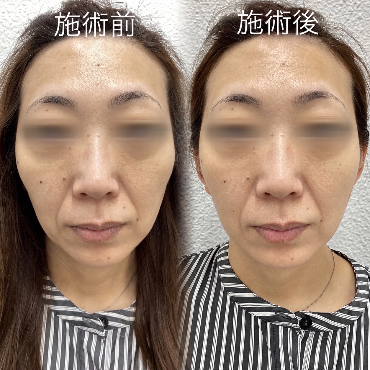 ジャルプロスーパーハイドロ 症例写真 施術前後