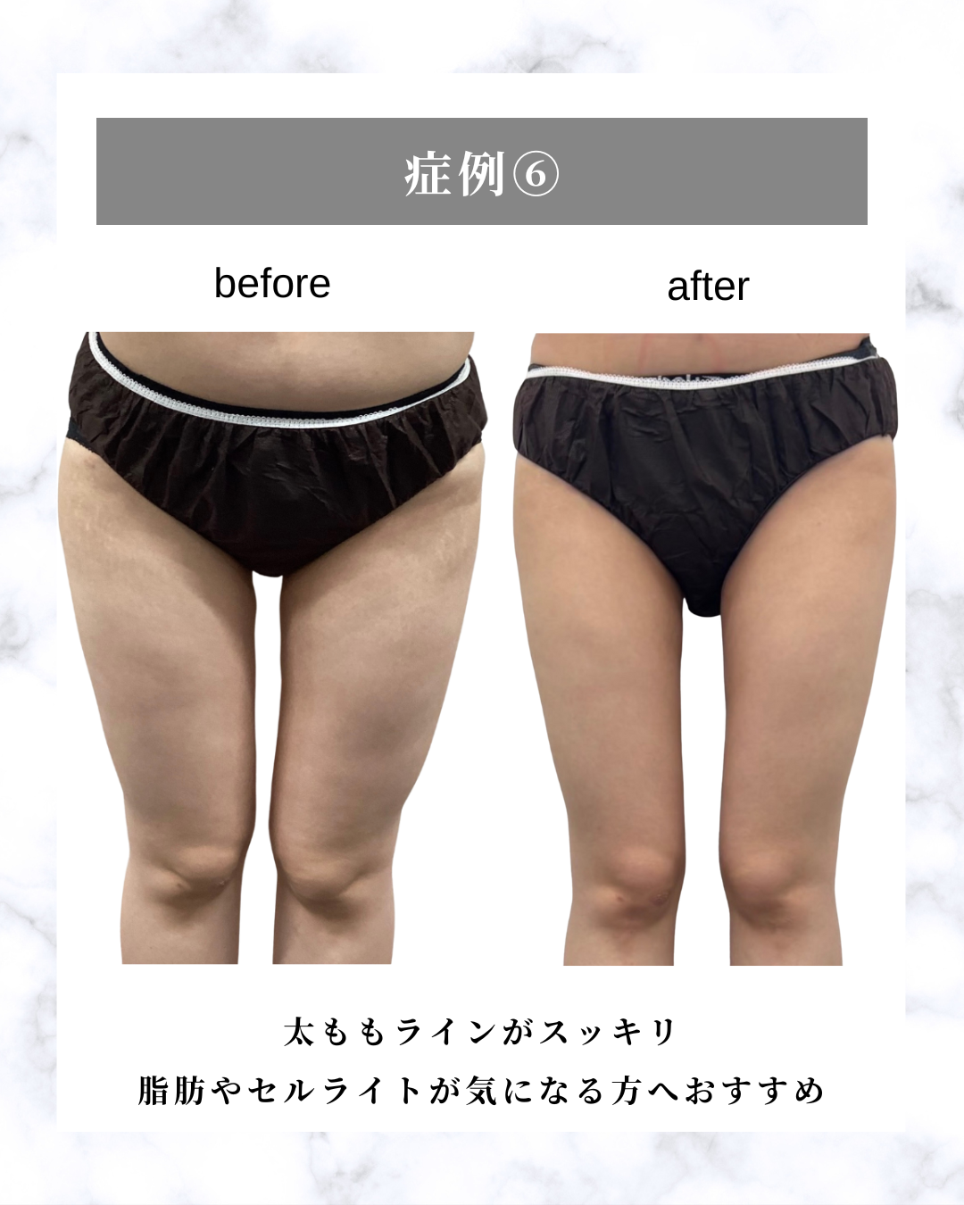 福岡天神 ミラウェーブボディ 下半身 症例写真