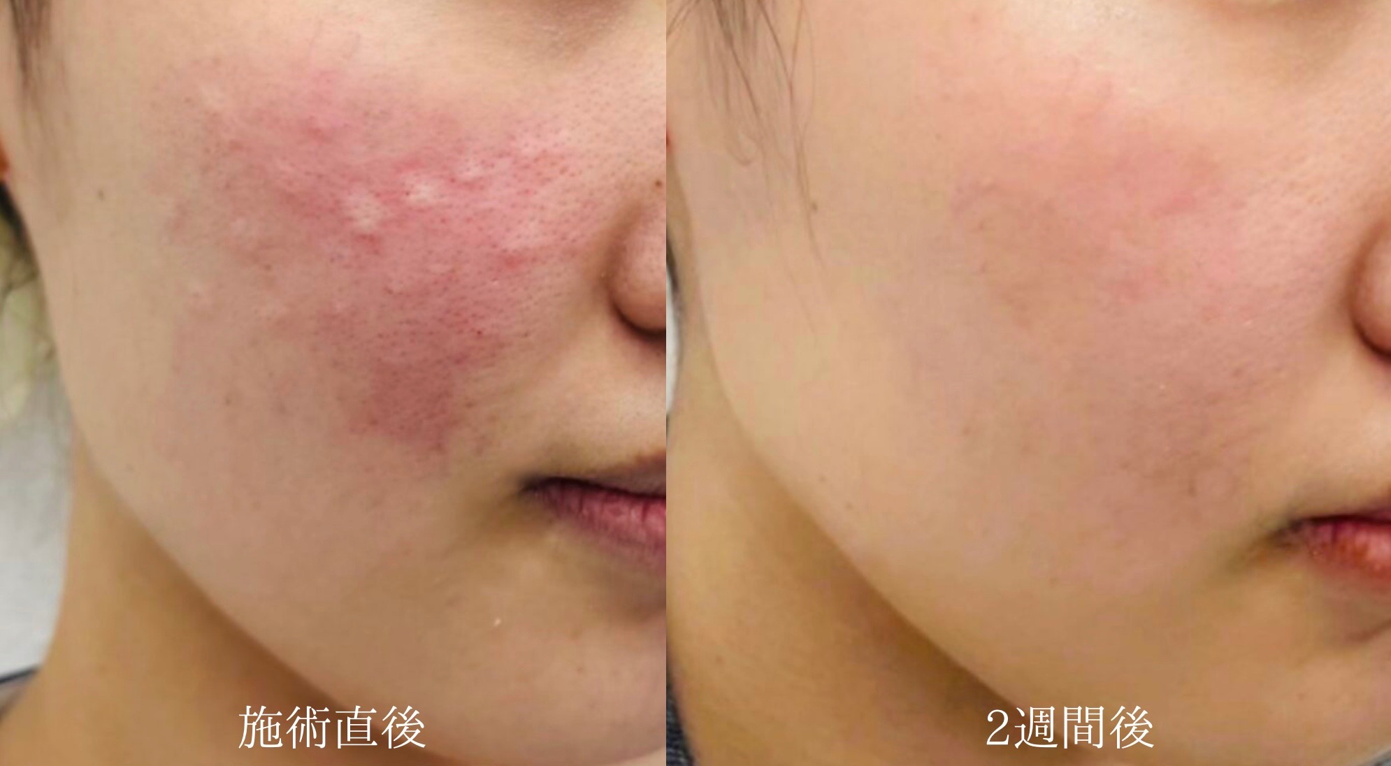 福岡 天神 リジュラン 症例写真 肌再生注射