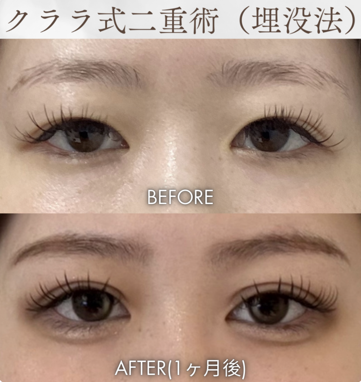 二重整形 症例 経過