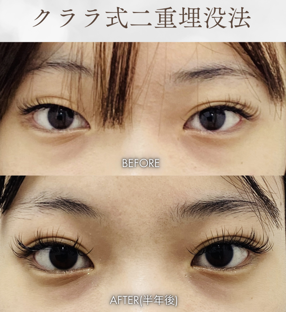 二重整形 症例 術後