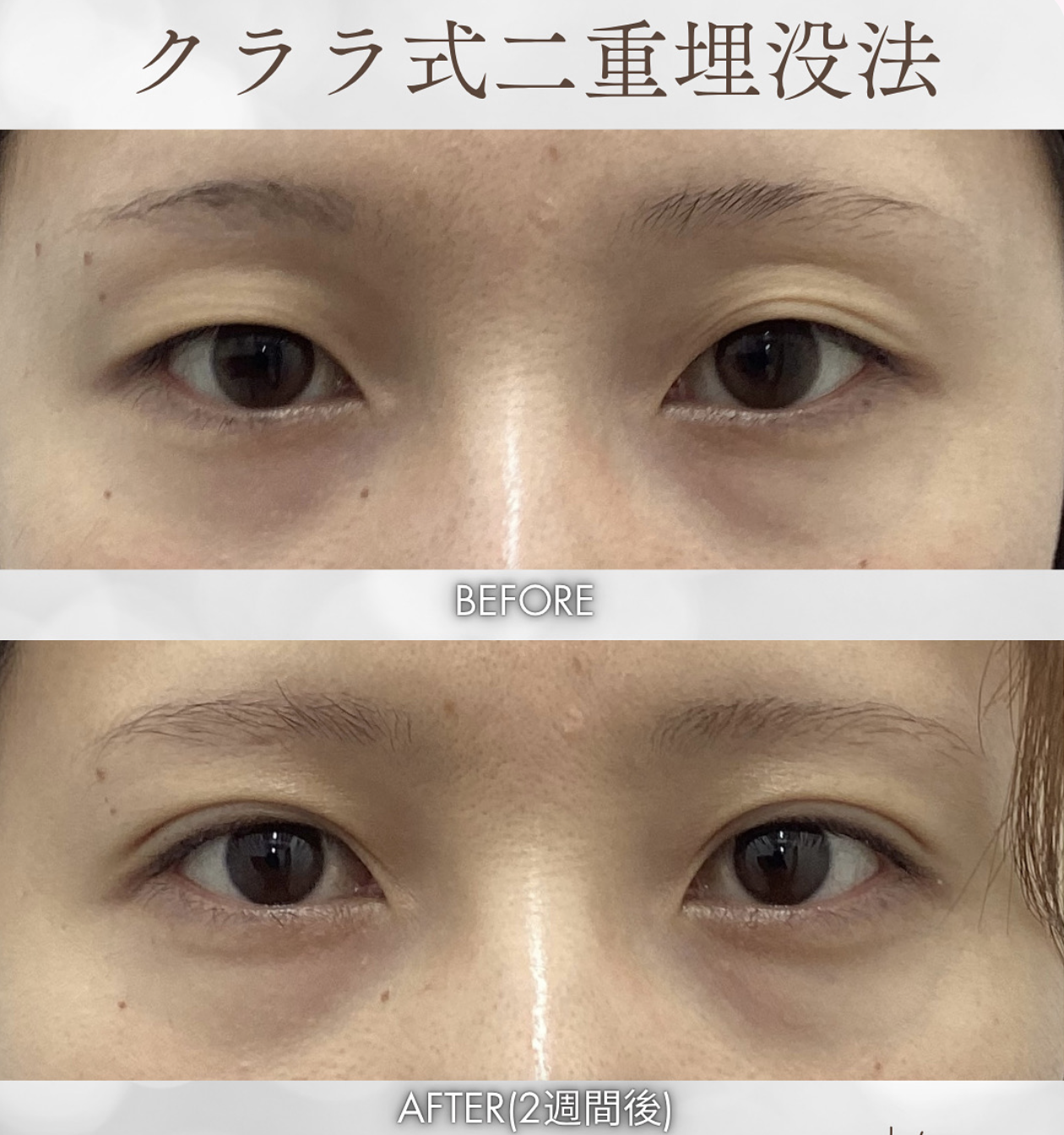 二重整形 症例 Before