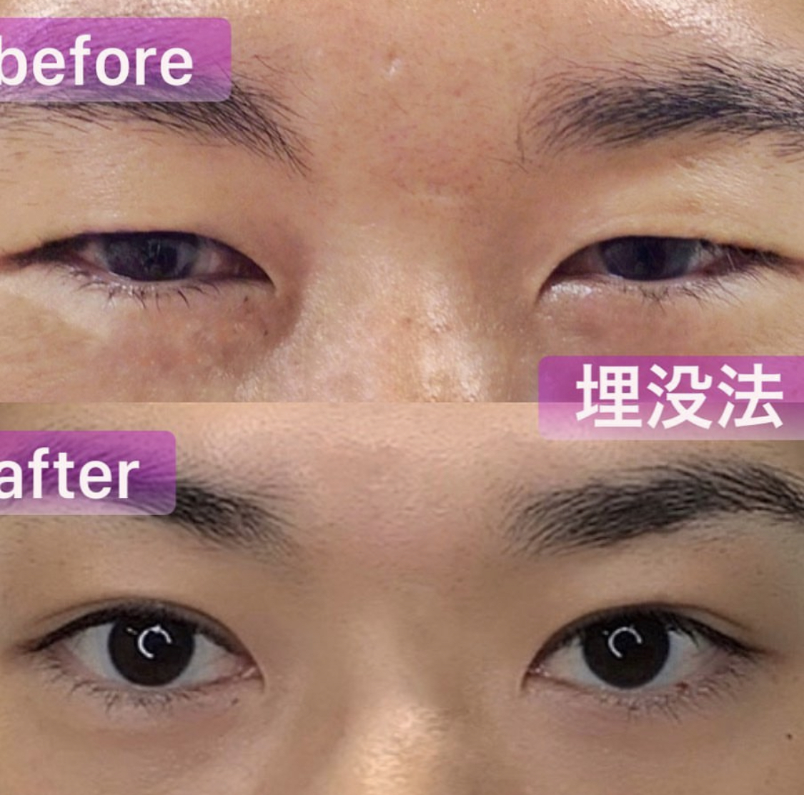 院長自身の二重埋没法 Before After