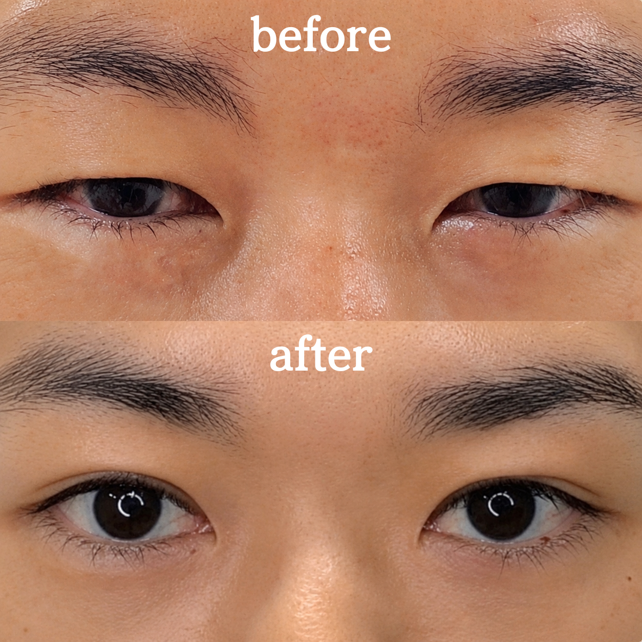 院長自身の二重埋没法 Before After