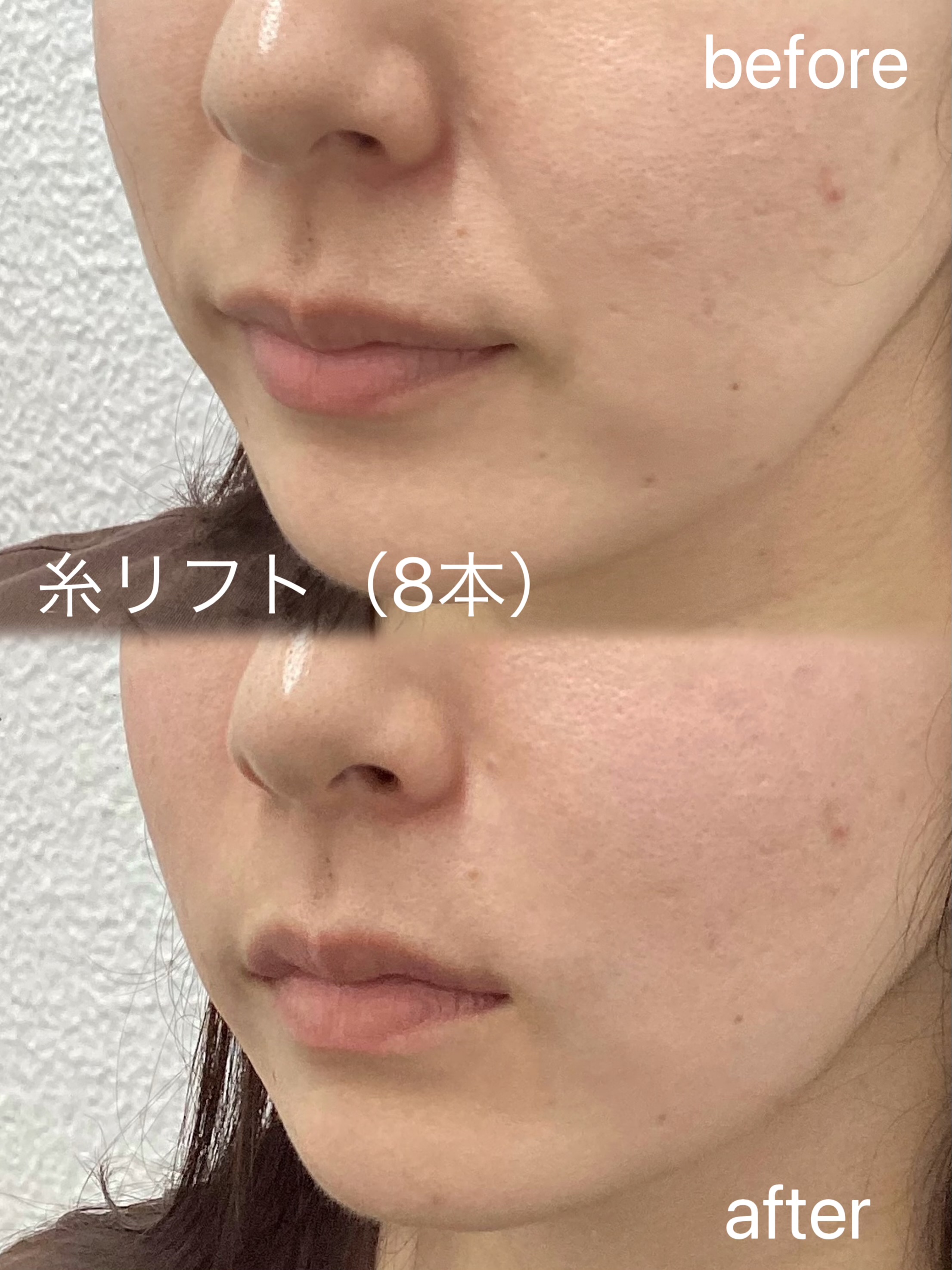 糸リフト 症例写真 斜め