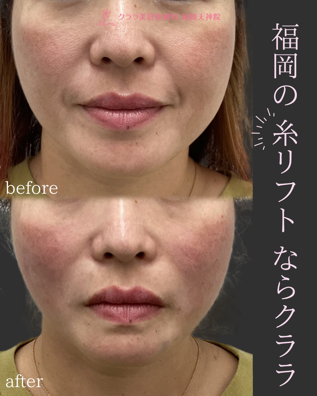 糸リフト 症例写真 正面