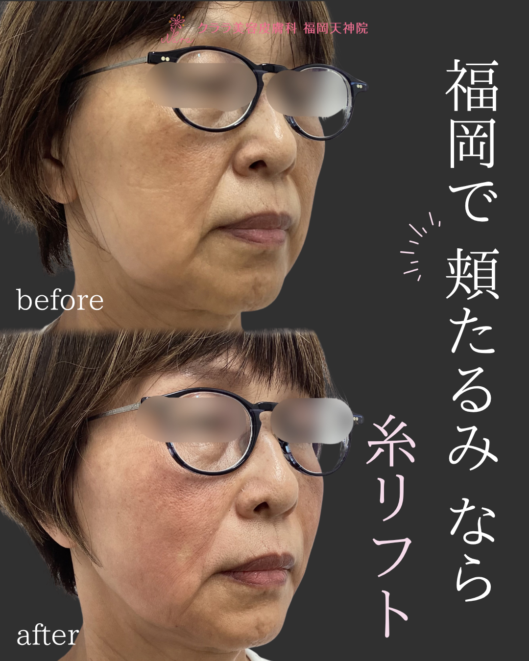 糸リフト 症例写真 斜め