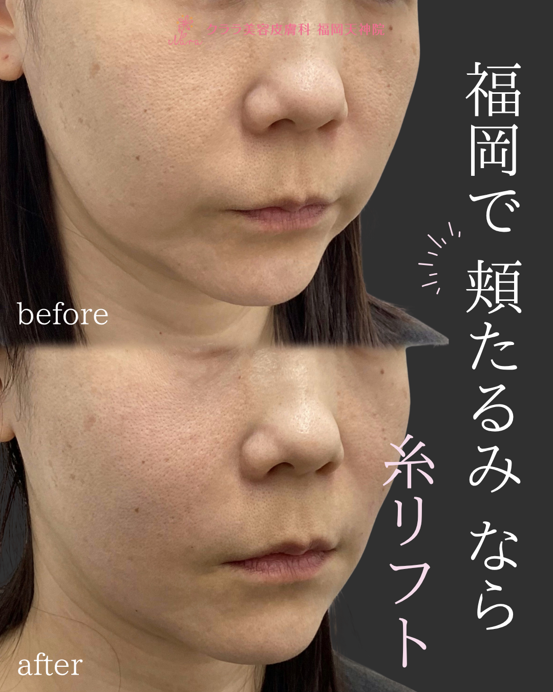 糸リフト 症例写真 斜め