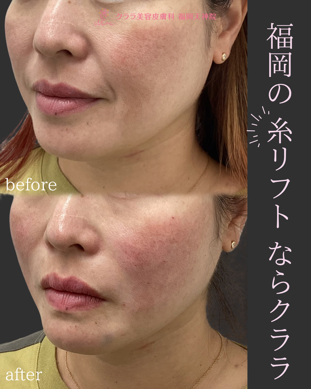 糸リフト 症例写真 斜め