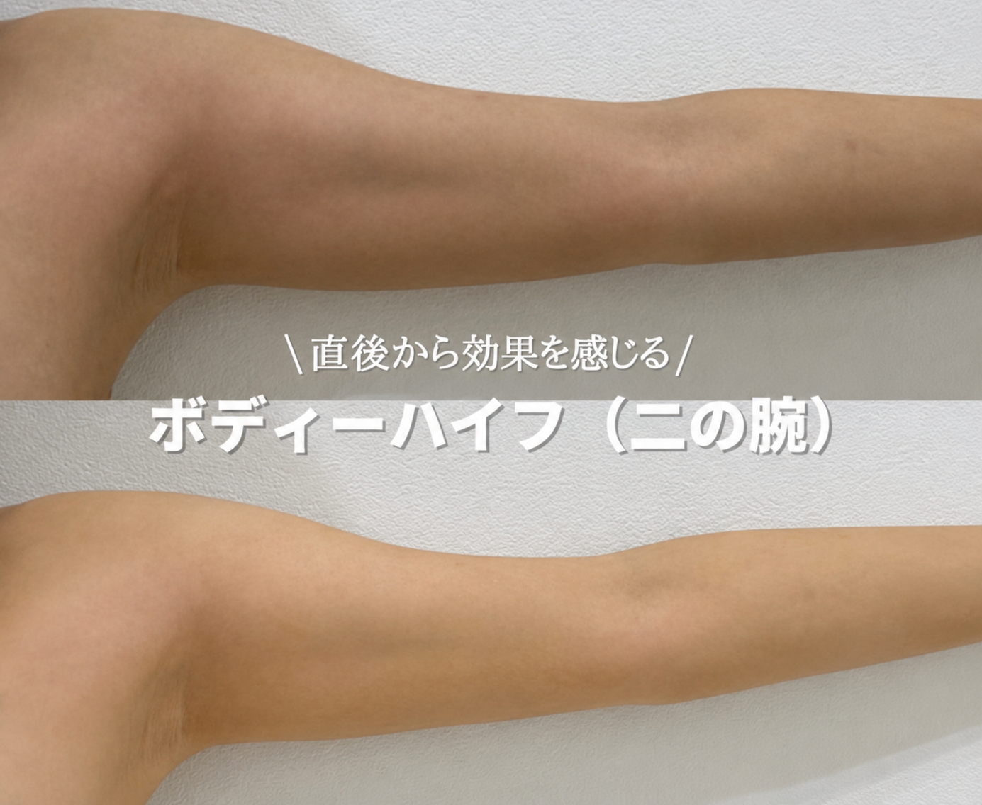 福岡 ボディハイフ 症例 二の腕