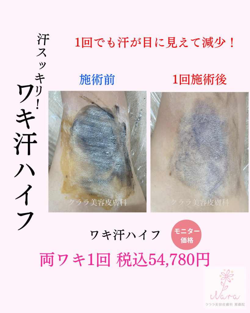 ワキ汗ハイフ 1回の効果 20代女性 | クララ美容皮膚科那覇院