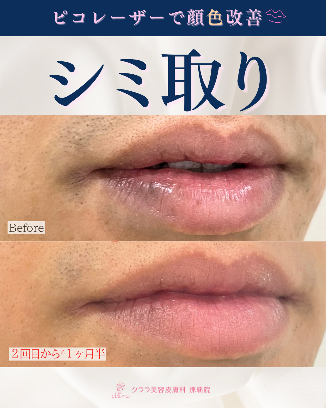 唇 色素 沈着