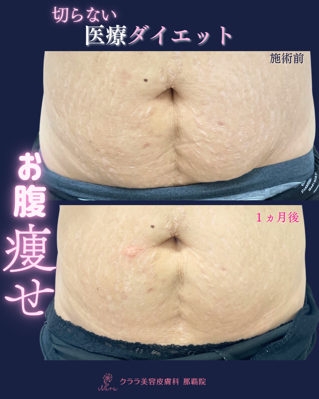 切らない医療ダイエット －ボディハイフ－ | クララ美容皮膚科 那覇院