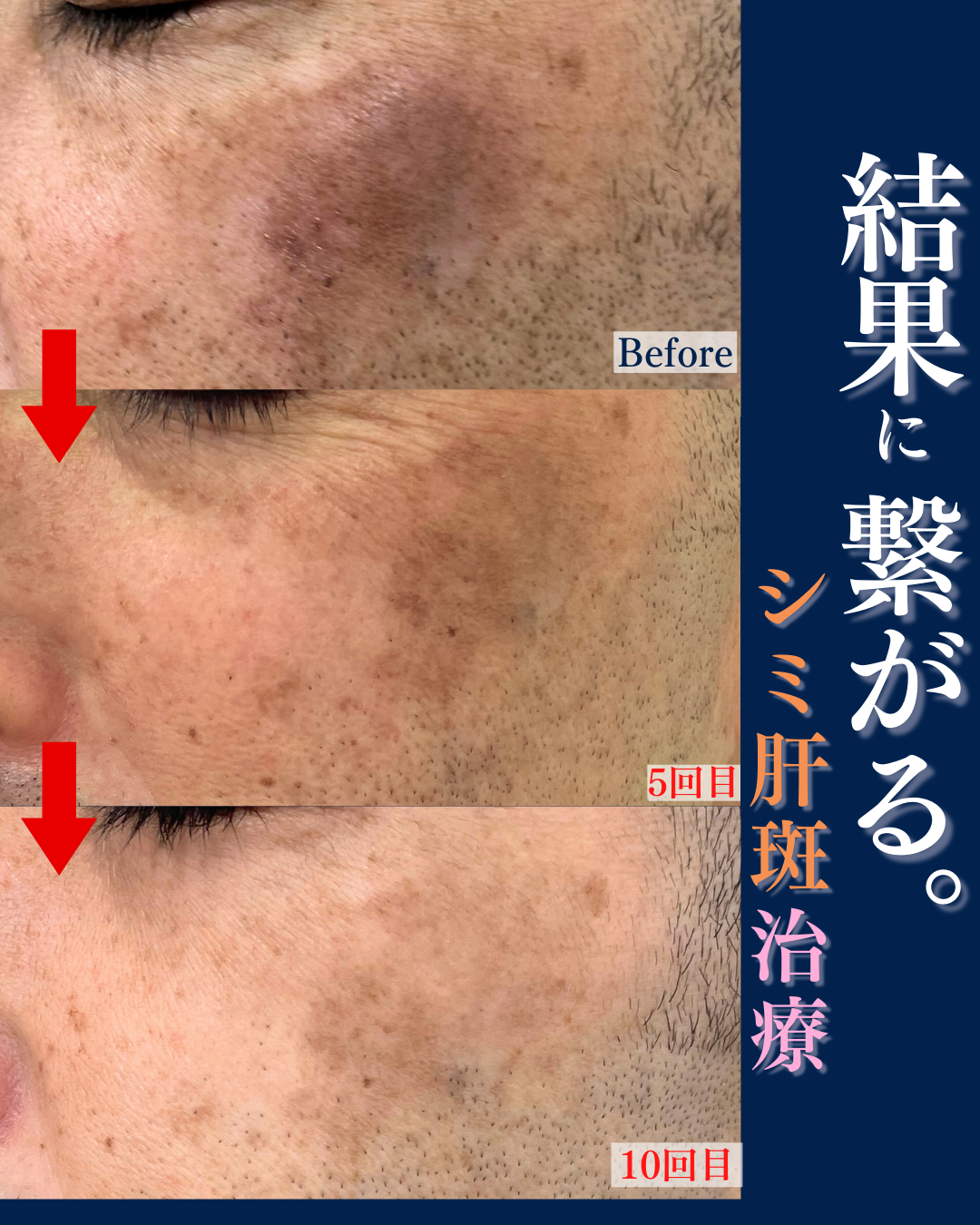 ピコ レーザー 肝 斑