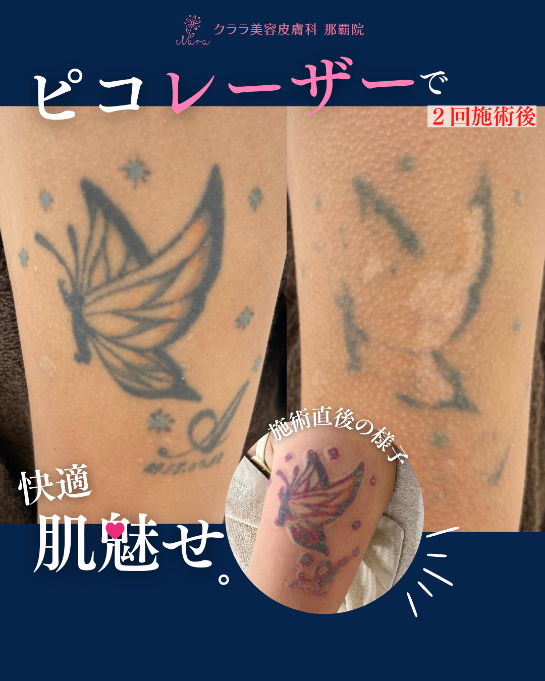 ピコレーザーで快適肌魅せ | クララ美容皮膚科 那覇院