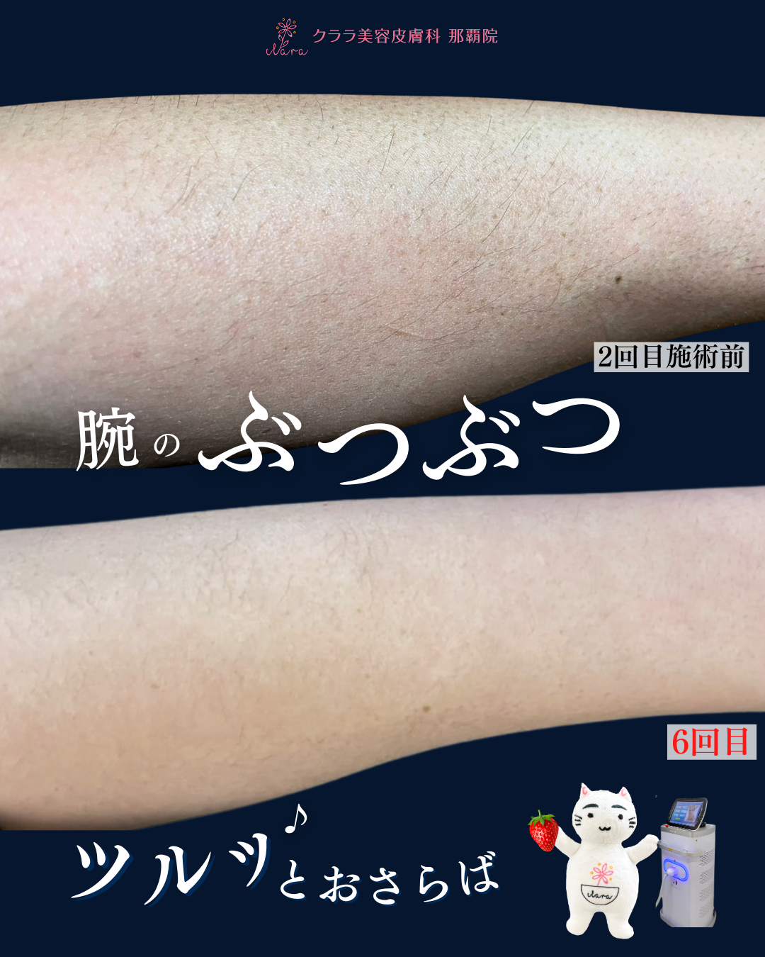 脱毛で肌のぶつぶつが消える！？ | クララ美容皮膚科 那覇院