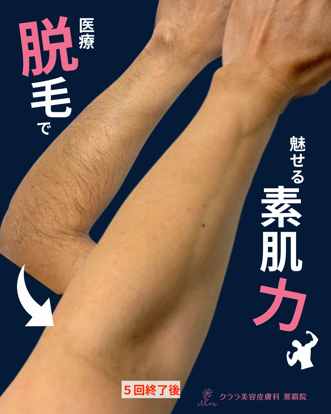 スライド①医療脱毛