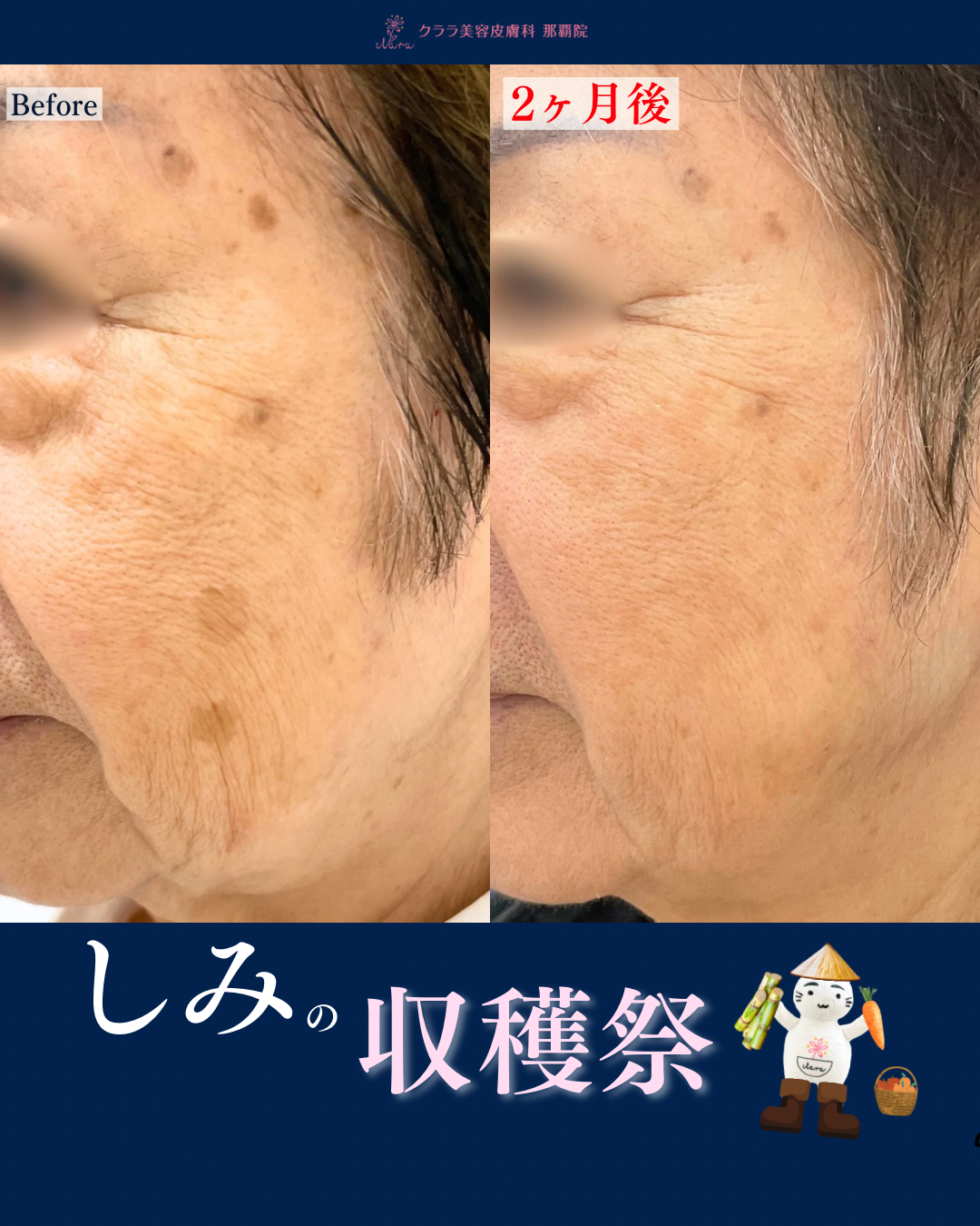 スライド②ピコスポット