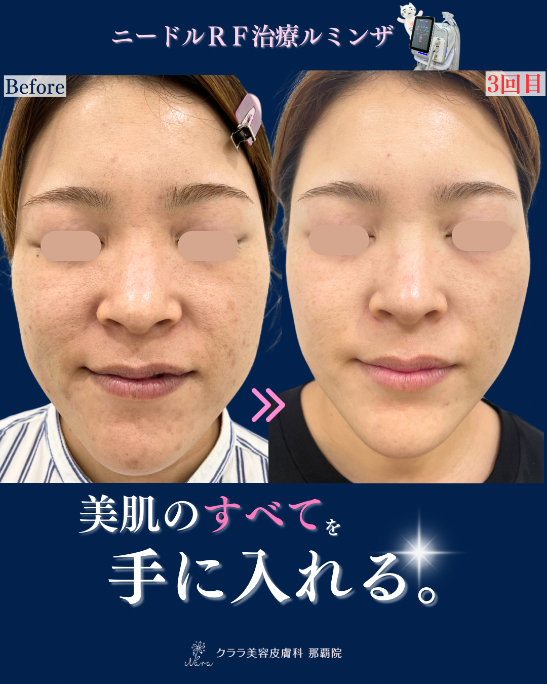 スライド④ルミンザ（美肌）