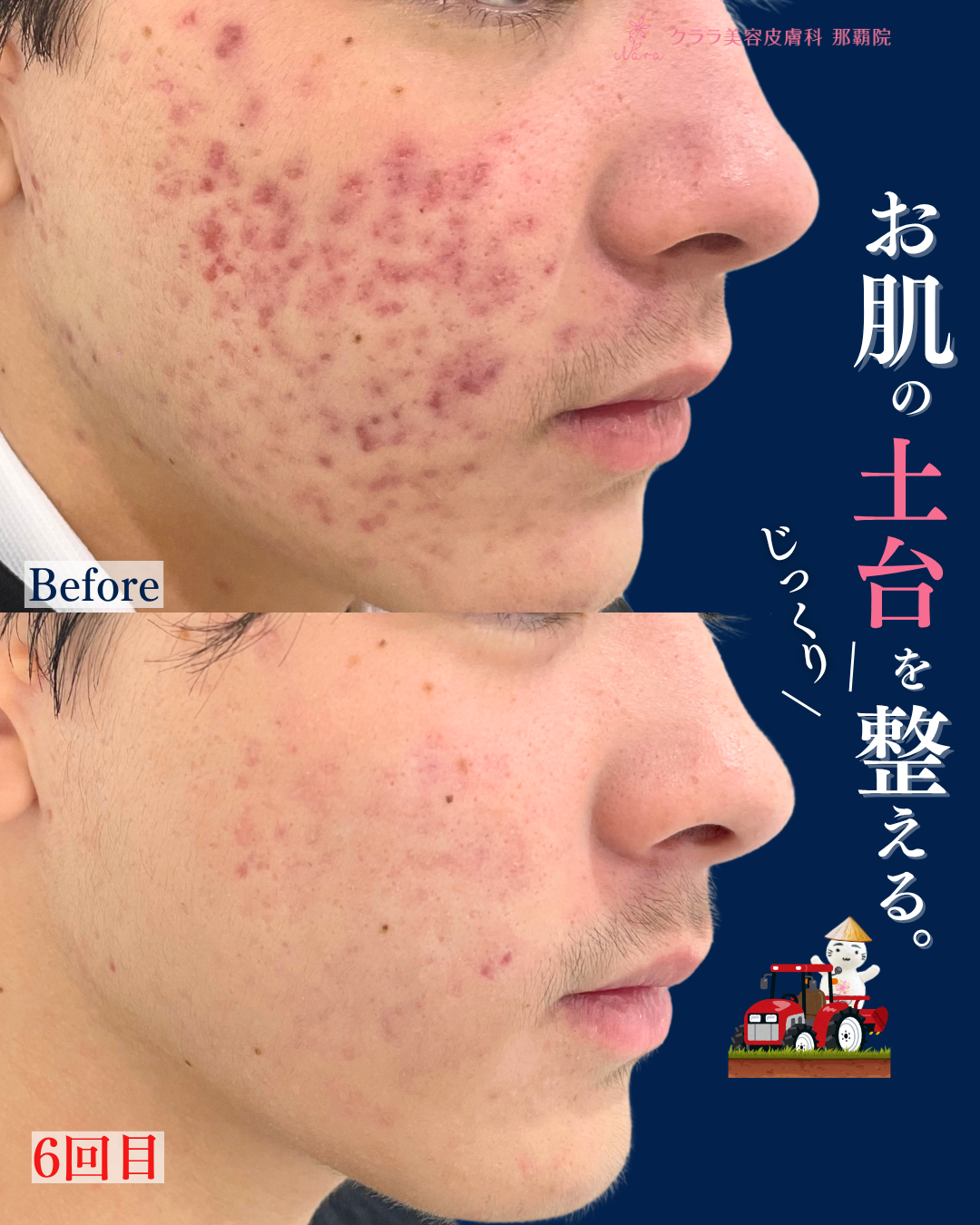 スライド⑤ルミンザ（ニキビ）