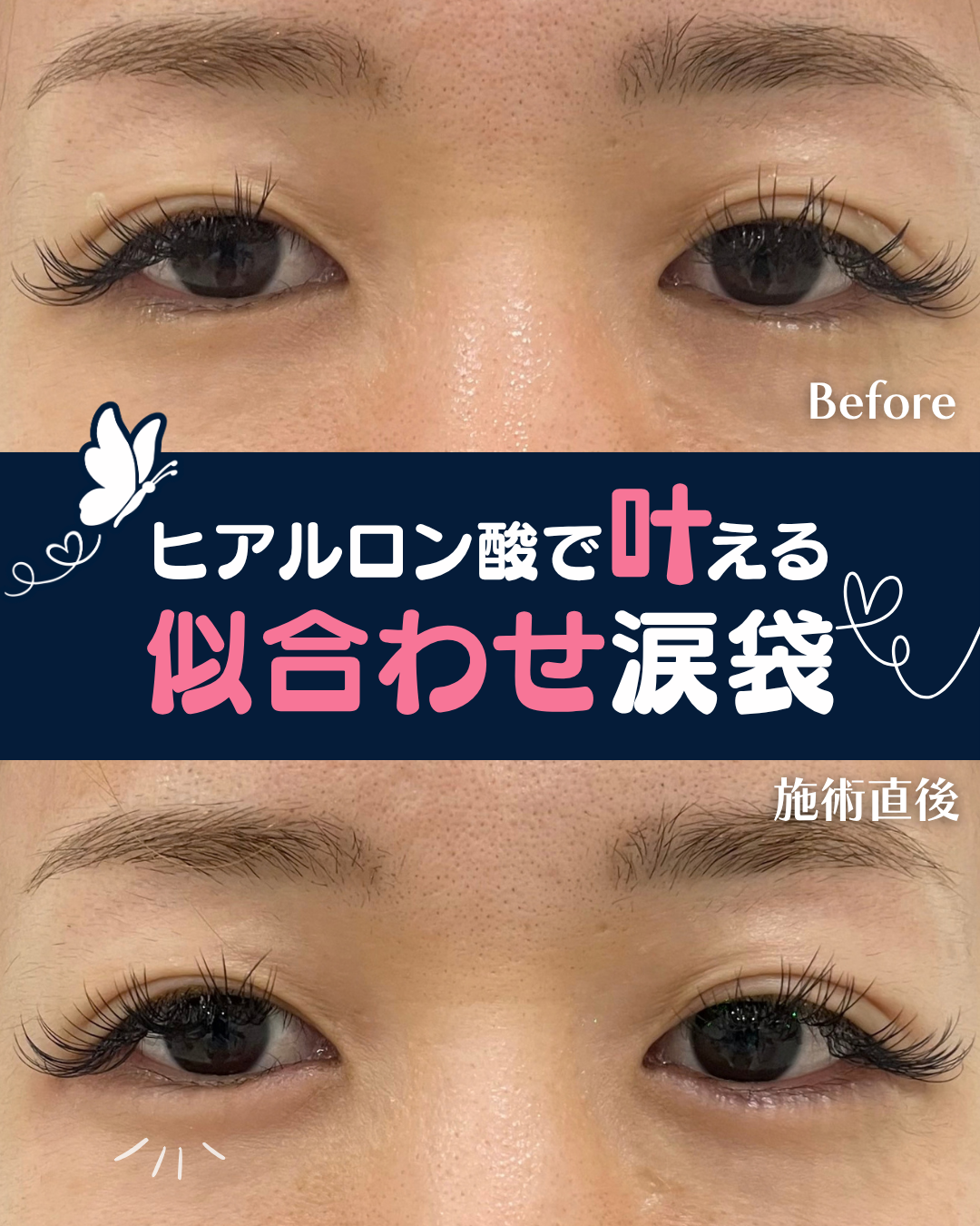涙袋ヒアルロン酸注入