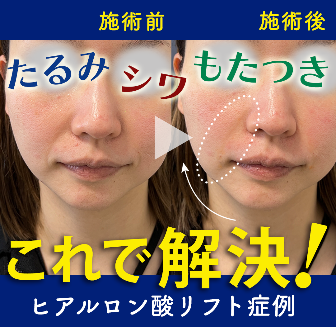 ヒアルロン酸リストアップ症例