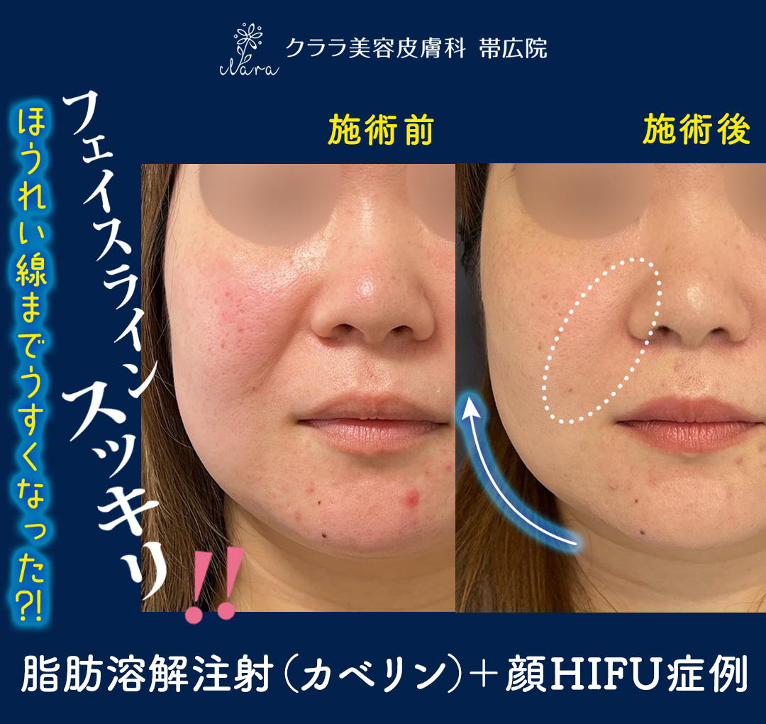 脂肪溶解注射＋顔HIFU症例