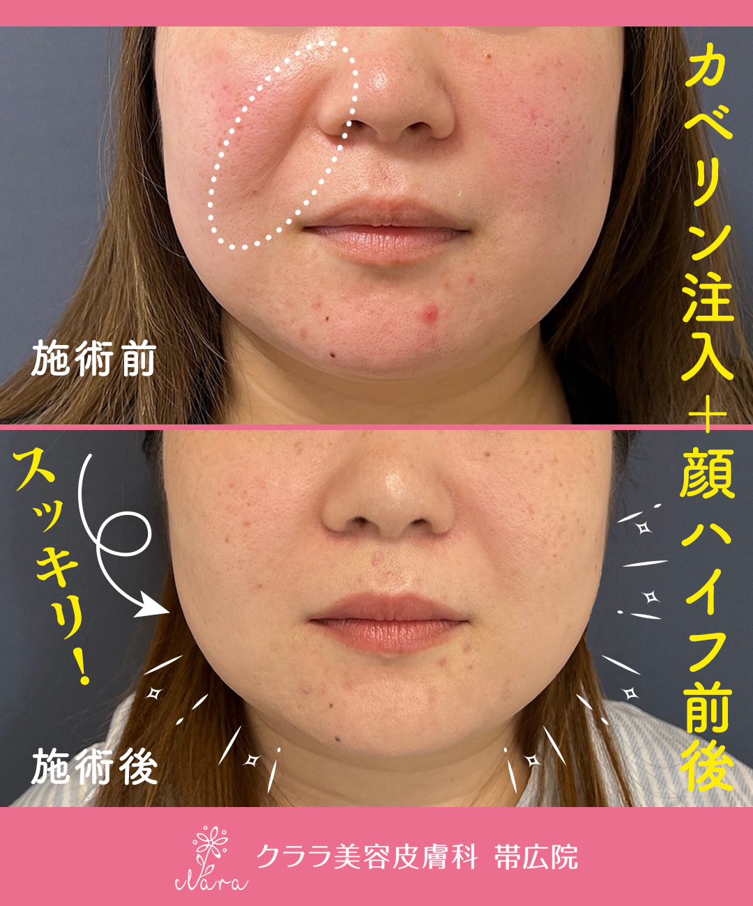 カベリン注入＋顔ハイフ前後