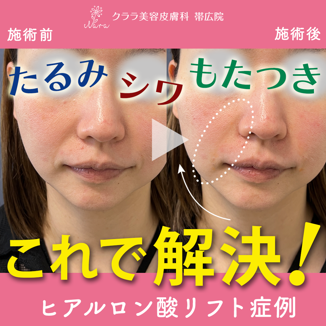 ヒアルロン酸リフト症例