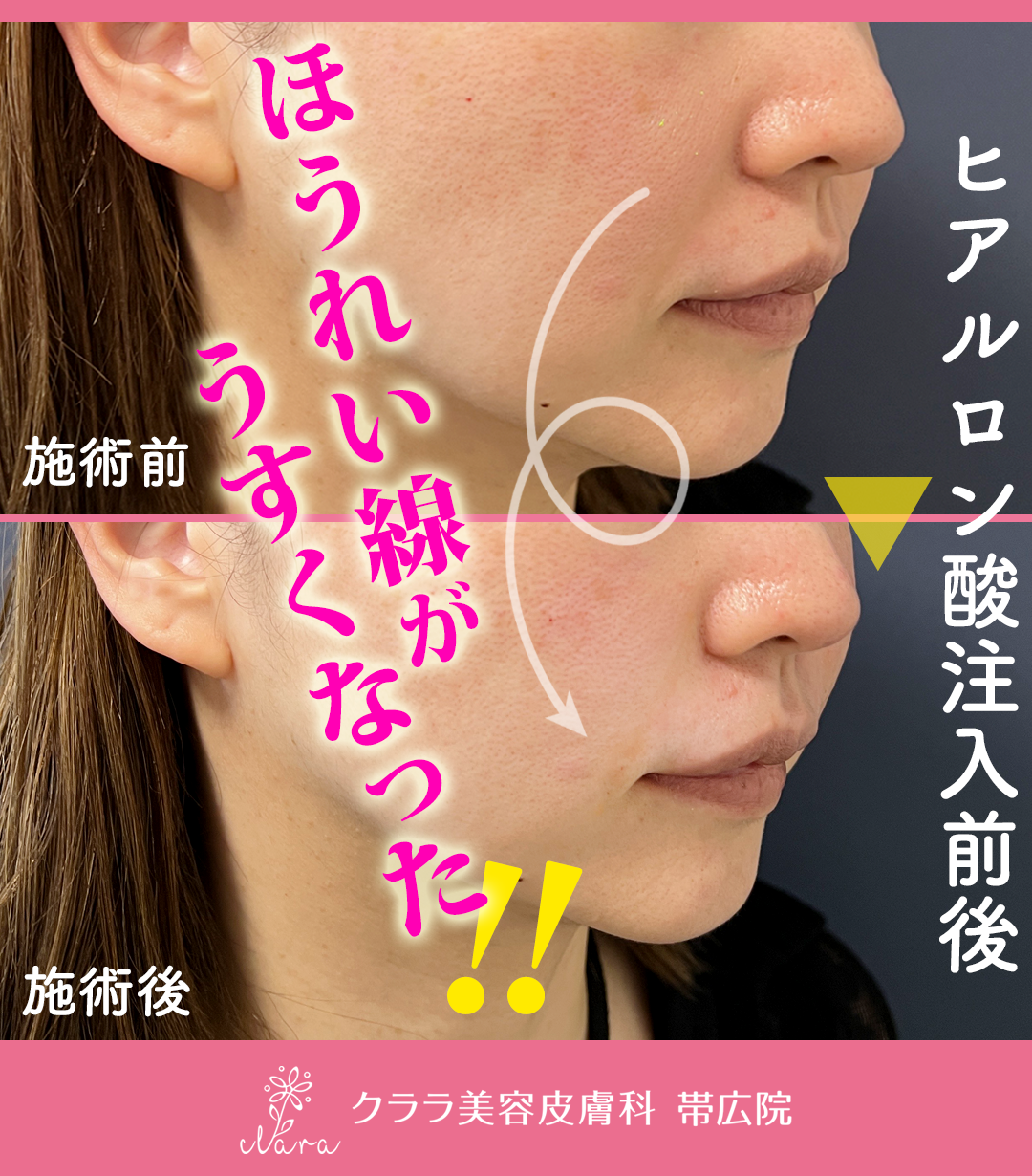 ヒアルロン酸リフトビフォーアフター